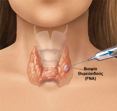 Thyroid FNA GR