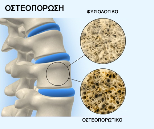 osteoporosis2