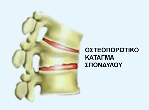 osteoporotic_fracture1